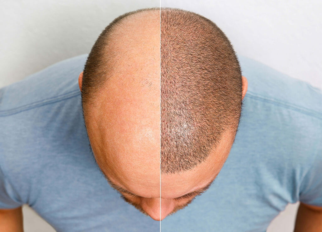 زرع الشعر في تايلند